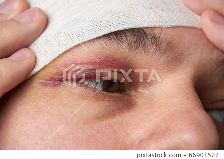 close view of a bruise near the eye, the face of a close view of a bruise near the eye, the face of a 66901522