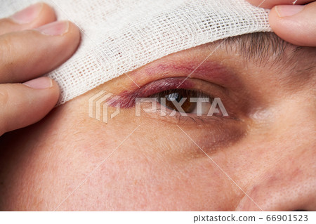 close view of a bruise near the eye, the face of a close view of a bruise near the eye, the face of a 66901523