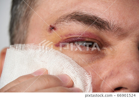 close view of a bruise near the eye, the face of a 66901524