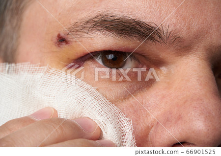 close view of a bruise near the eye, the face of a close view of a bruise near the eye, the face of a 66901525