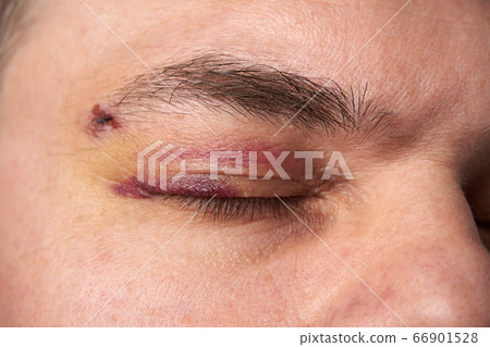 close view of a bruise near the eye, the face of a close view of a bruise near the eye, the face of a 66901528