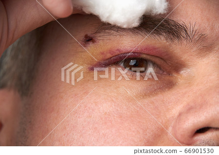close view of a bruise near the eye, the face of a 66901530