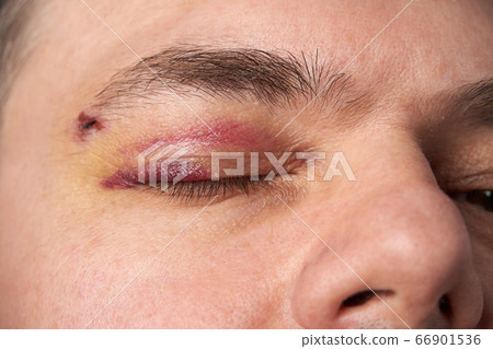 close view of a bruise near the eye, the face of a 66901536