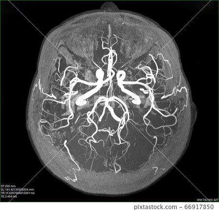 MRI of the blood vessels i 66917850