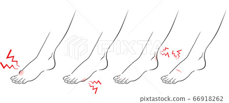 拇外翻，外翻小腳趾腳煩 66918262