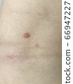 Water wart 66947227
