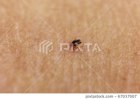 Tick bitten in human skin 7 67037007