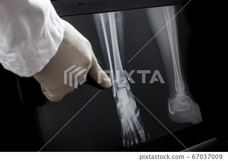 X-ray after operation for the leg 67037009