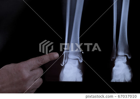 X-ray after operation for the leg 67037010