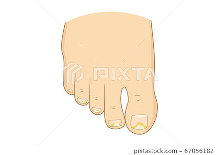 Toenail mycosis vector illustration. Toenail mycosis vector illustration. 67056182