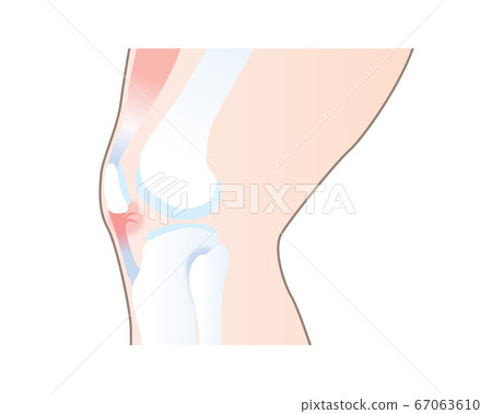 Illustration of damaged patella ligament Illustration of damaged patella ligament 67063610
