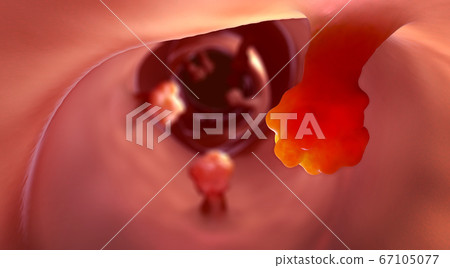 Close-up view of intestinal polyps and diseased intestinal tissue 67105077