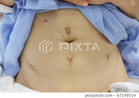 Women myoma case after myomectomy by laparoscopy 67149514