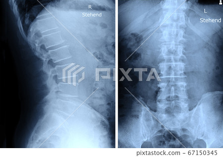 x-ray images spine 67150345