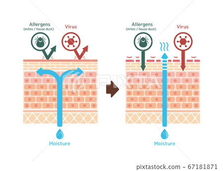 Healthy skin and atopic dermatitis comparative cross-section illustration (English) 67181871