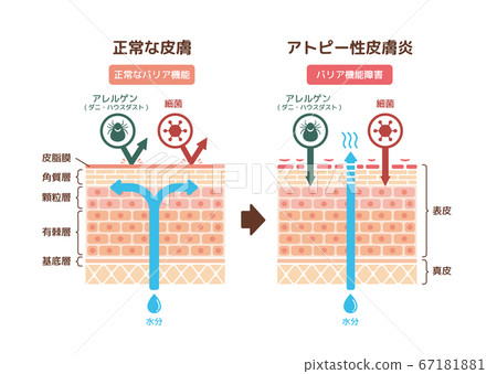 健康的皮膚和特應性皮炎的橫截面插圖 67181881