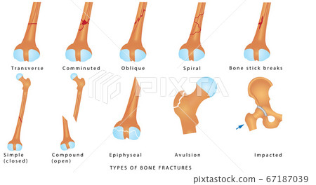 Types of Bone Fractures Types of Bone Fractures 67187039