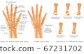 Thumb Fractures 67231702
