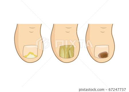 Toenail mycosis types. 67247737