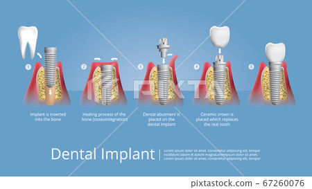 Human teeth and Dental implant Vector Illustration Human teeth and Dental implant Vector Illustration 67260076