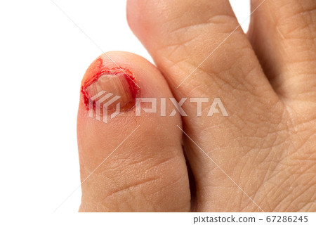 Bleeding from an injury on the little toe Bleeding from an injury on the little toe 67286245