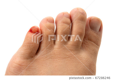 Bleeding from an injury on the little toe Bleeding from an injury on the little toe 67286246