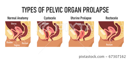 Types of pelvic organ prolapse - cystocele, uterine prolapse, rectocele 67307162