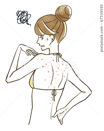 Woman suffering from back acne 67339595