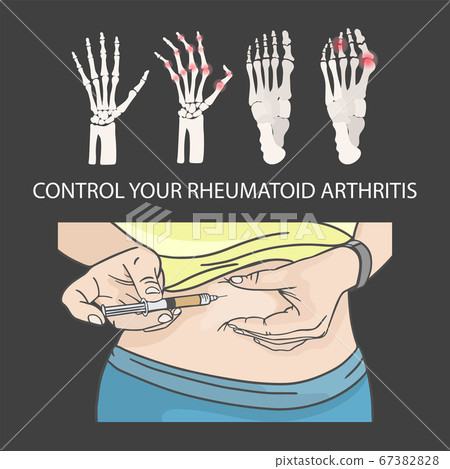 RHEUMATOID ARTHRITIS CONTROL Hypodermic Injection In Stomach Medical Human Illness Vector Illustration Set 67382828