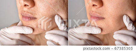 Skin problems and acne scar, Before and after acne facial care treatment, Beauty concept Skin problems and acne scar, Before and after acne facial care treatment, Beauty concept 67385303