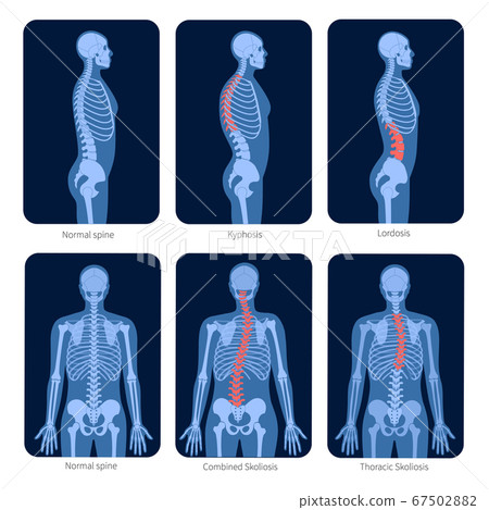 Spine X ray Spine X ray 67502882