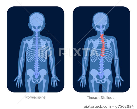 Spine X ray 67502884