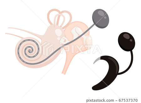 人工耳蝸植入裝置的圖示 67537370