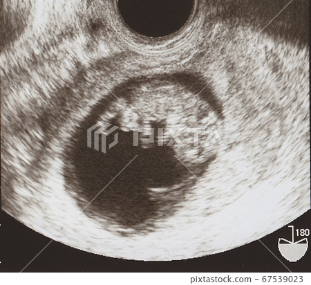 Echo pictures of the fetus Echo pictures of the fetus 67539023