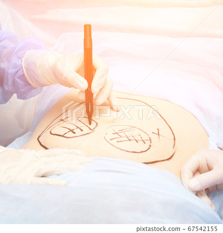 liposuction operation. Doctor hands near belly liposuction operation. Doctor hands near belly 67542155