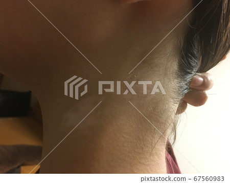 紫外線治療對白癜風的影響 紫外線治療對白癜風的影響 67560983