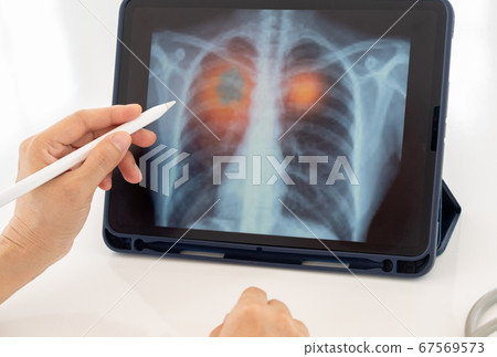 Pneumonia medical x-ray Pneumonia medical x-ray 67569573