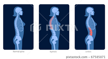 Spine X ray Spine X ray 67585871