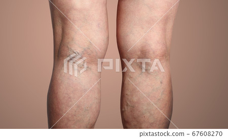 The varicose veins on a legs of woman The varicose veins on a legs of woman 67608270
