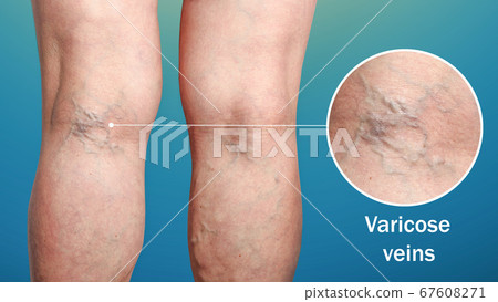 The varicose veins on a legs of woman The varicose veins on a legs of woman 67608271