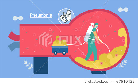 Treatment and clean alveoli. Treatment and clean alveoli. 67610425