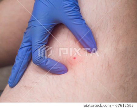 The doctor examines a red spot on the patient s leg after being bitten by an insect. The concept of an allergic skin reaction after being bitten by mosquitoes and bees, close-up, treatment 67612592