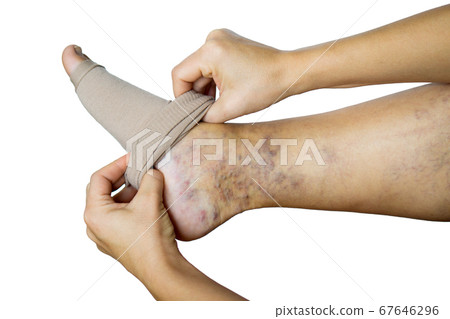 a woman puts a compression stocking on her leg with varicose veins. Varicose veins prevention, Compression tights, relief for tired legs. female legs in stockings. 67646296