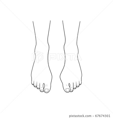 Hallux valgus, bunion. 67674301