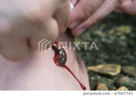Series of leech biting on leg being repel with salt Series of leech biting on leg being repel with salt 67687743