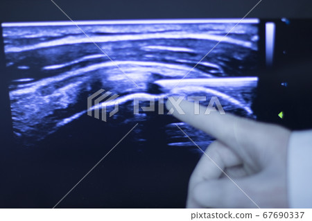 EPI dry needling ultrasound scan 67690337