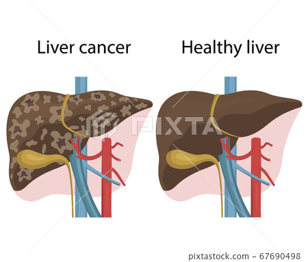 Vector illustration  liver disease 67690498