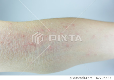 Eczema on the arm 67703587
