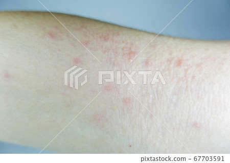 Eczema on the arm 67703591