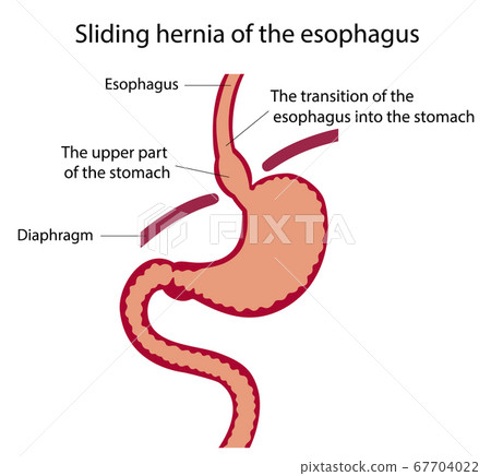 Vector illustration of stomach disease.  67704022
